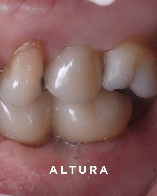 I-S-OT-TEETH,Wilson Kim (1)