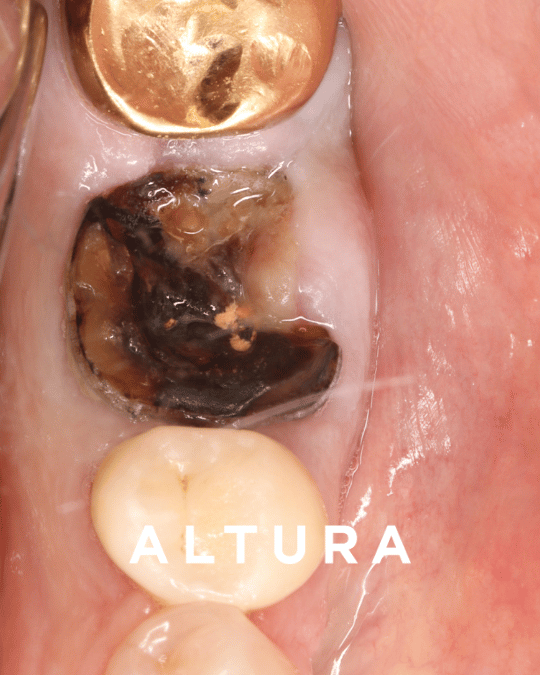 I-S-OT-TEETH-Molar1 (1)