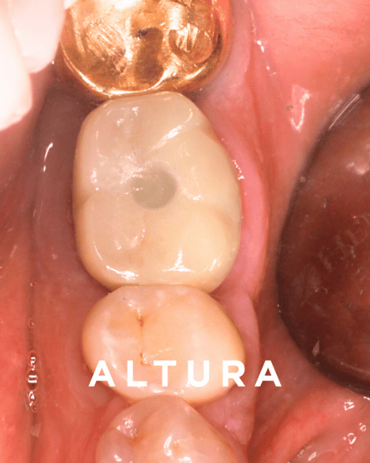 I-S-OT-TEETH-Molar1