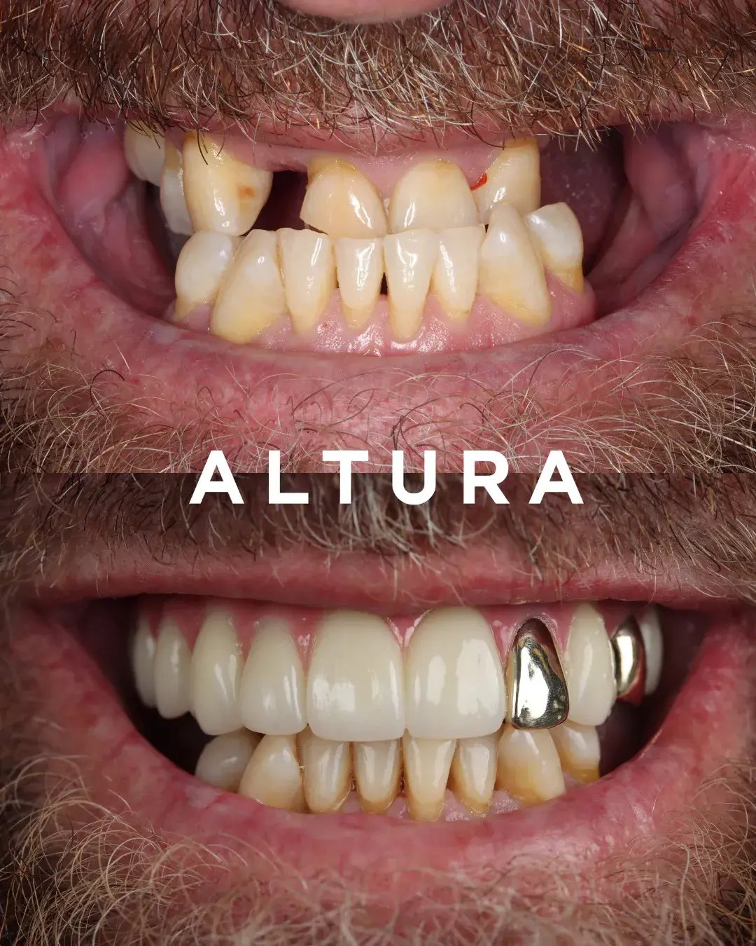 teeth 4